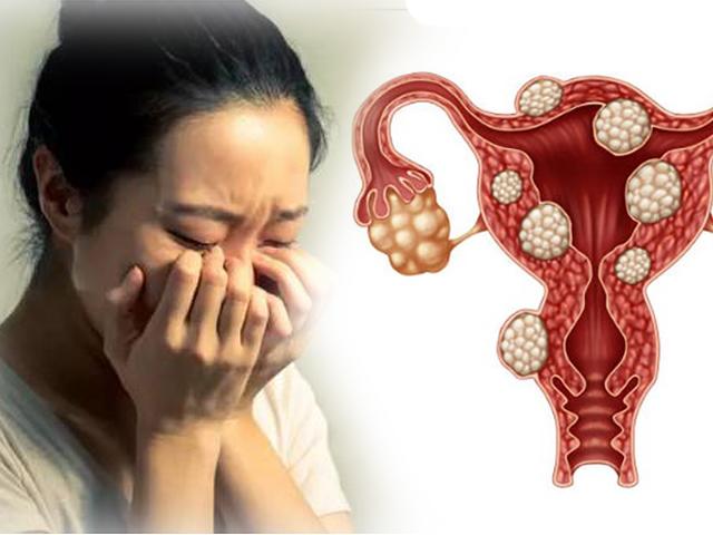Thiếu nữ mọc 36 khối u xơ tử cung vì ăn thịt: 7 thực phẩm phụ nữ phải tránh