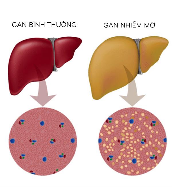 Sức khỏe, đời sống: nguồn cội của bệnh gan nhiễm mỡ ở người ? Gan-nhiem-mo-do-1-tuy-nhe-nhung-cung-khong-the-chu-quan-262-mo-u-dong-trong-gan-1521105115-887-width600height653