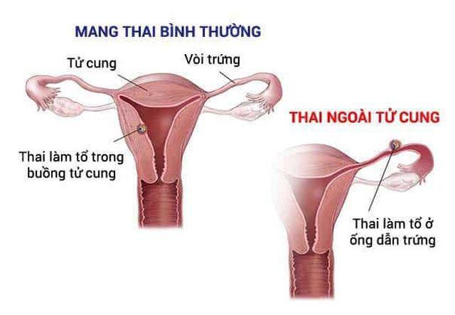 nguoi phu nu chet sau 12 gio dau bung, loi canh tinh cho chi em o do tuoi sinh de - 3