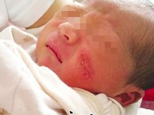 Sinh mổ, bà mẹ đau lòng khi xem mặt con gái thấy vết cắt dài trên má