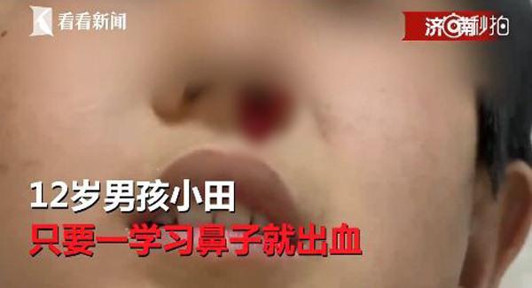 cau be chay mau cam 20 lan mot ngay moi khi hoc bai, ngay ca bac si cung "bo tay" - 2