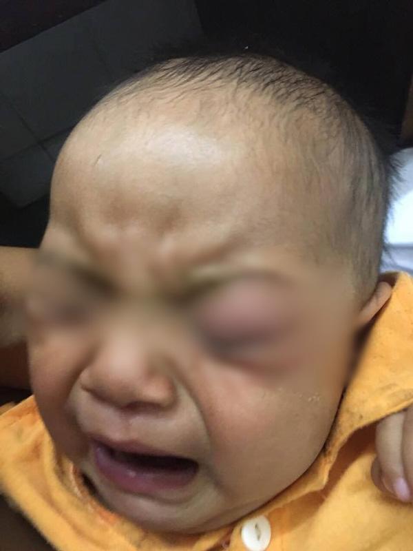 me vat sua chua do mat cho con, be trai 7 thang tuoi phai bo mot mat vi hoai tu - 2