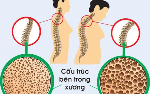 benh loang xuong dang tre hoa, lieu ban da biet cach phong ngua? - 2