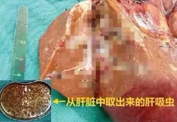 di kham hong, ai ngo lai phat hien tram thu kinh di trong gan chi vi thich an mon nay - 1