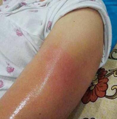 be 3 tuoi bi me do nuoc nong vao tay, chong sau khi biet ly do lai dong tinh - 1