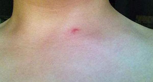 tuong vet muoi dot tren nguoi, nam thanh nien may man thoat nan khi som nghe loi ban gai - 1