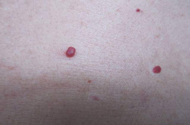 tuong vet muoi dot tren nguoi, nam thanh nien may man thoat nan khi som nghe loi ban gai - 3