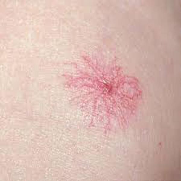 tuong vet muoi dot tren nguoi, nam thanh nien may man thoat nan khi som nghe loi ban gai - 2