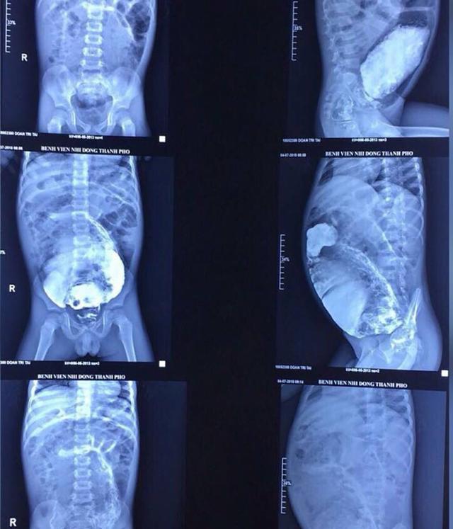 be trai bung phinh to nhu bau vi bi tao bon 5 nam, nhin phim chup con giat minh hon - 1