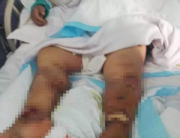 nguoi phu nu chet do nhiem khuan khi lam tom, loai vi khuan nay giet nguoi trong 48 tieng - 1