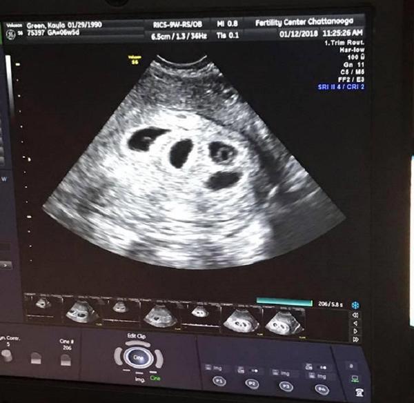 mong cho mai moi co bau, ket qua sieu am thai lan dau khien ba me sung nguoi - 3