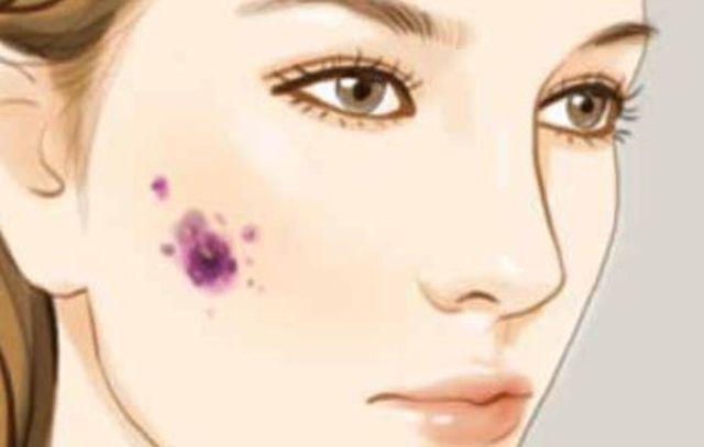 co gai 26 tuoi bi ung thu sau khi tay not ruoi, 10 kieu not ruoi can di kham gap - 1