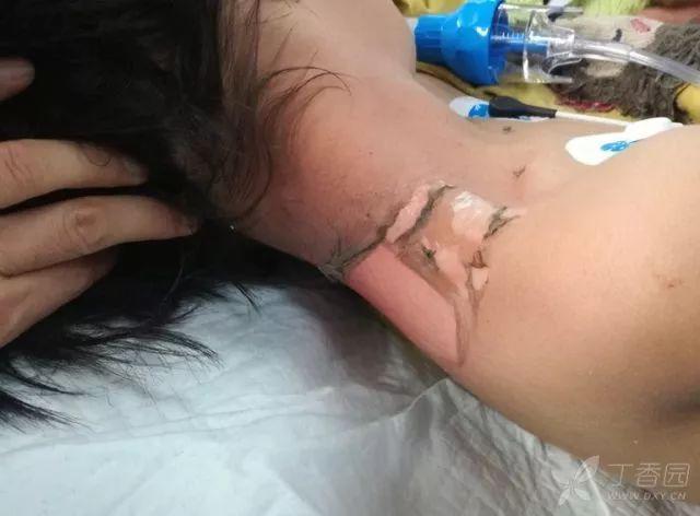 be gai bi co giat suyt tu vong chi vi ba dung cach nay de tri chay cho chau - 1