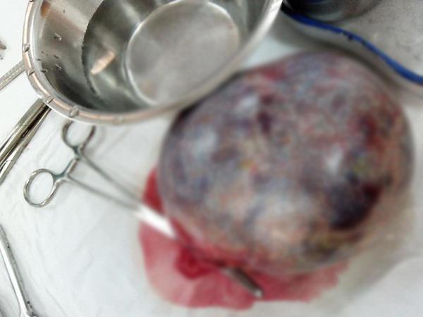 dau bung du doi khi mang thai 13 tuan, thieu nu nhap vien phat hien dieu khung khiep - 1