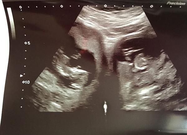 sieu am thai 20 tuan, me dung hinh khi biet ca the gioi chi co khoang 100 ca nhu minh - 1