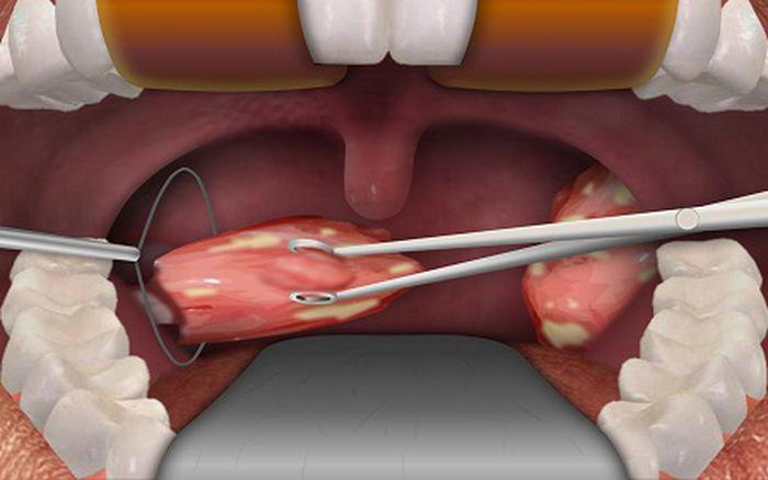 tre bi viem amidan khi nao can phai phau thuat? - 5