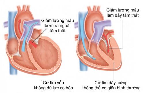 suy tim - hiem hoa khon luong doi voi suc khoe - 2