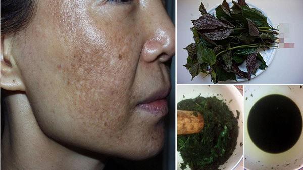 moi ngay bo ra chua den 5 ngan de so huu 4 cach tri nam da hieu qua tan goc - 6