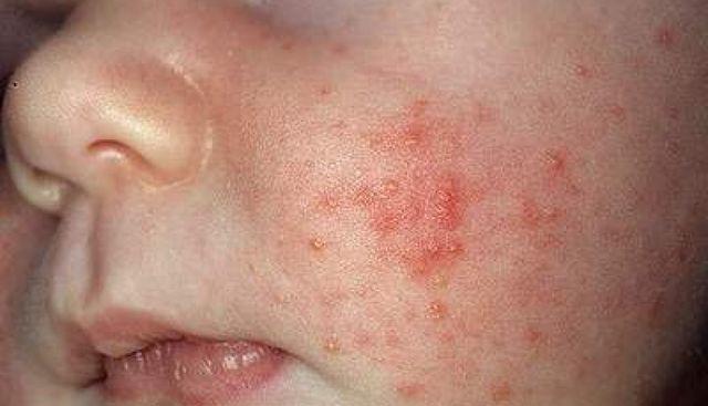 tre 10 thang tuoi da moc rau, beo phi, nghe thong bao cua bac si cha me khoc nuc no - 2