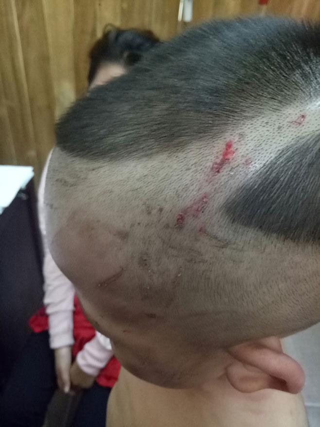 thong tin "soc" vu be 3 tuoi bi cha duong danh da man o phu quoc - 3