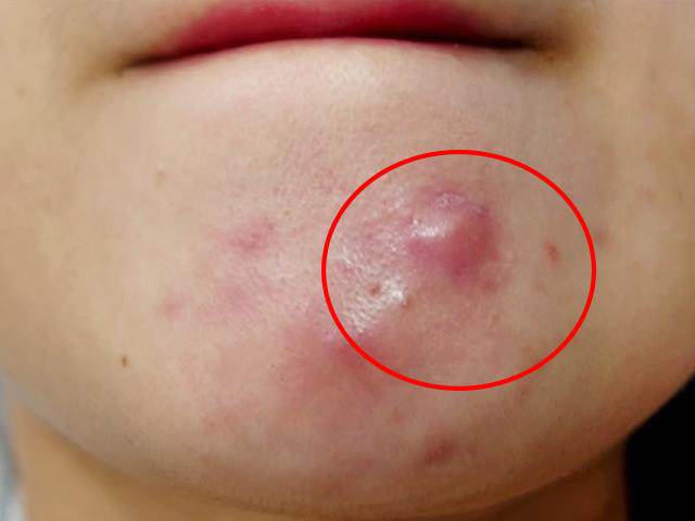 co ngay 10 cach tri mun boc cuc de ngay tai nha ma cac co nang khong nen bo qua - 1